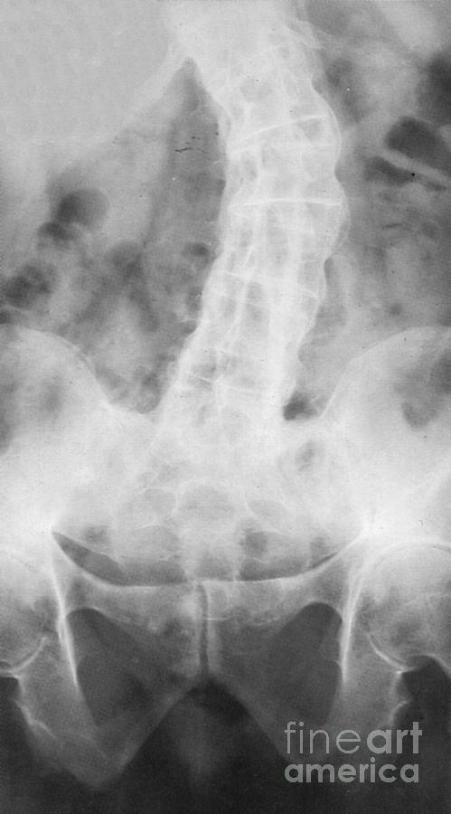 cervical ankylosing spondylitis x ray