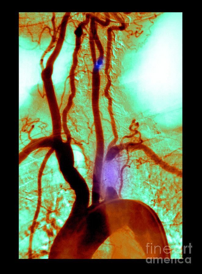 Aortic Arch Angiogram Photograph by Medical Body Scans