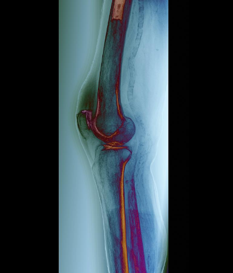 Human Photograph - Arteritis Of The Knee, X-ray #1 by Zephyr