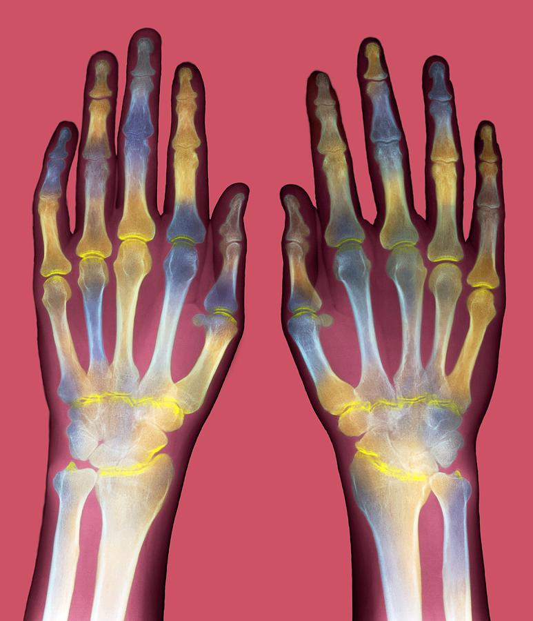 Rheumatoid Arthritis Photograph - Arthritic Hands, X-ray #1 by Du Cane Medical Imaging Ltd