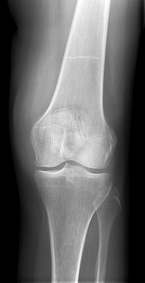 Arthritic Knee, X-ray Photograph by Du Cane Medical Imaging Ltd - Fine ...