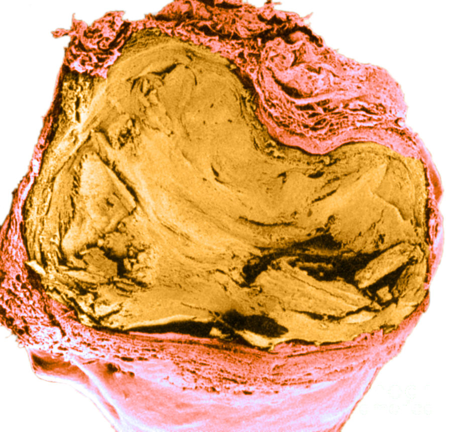 Atherosclerosis Sem, Full Blockage #1 Photograph by Science Source