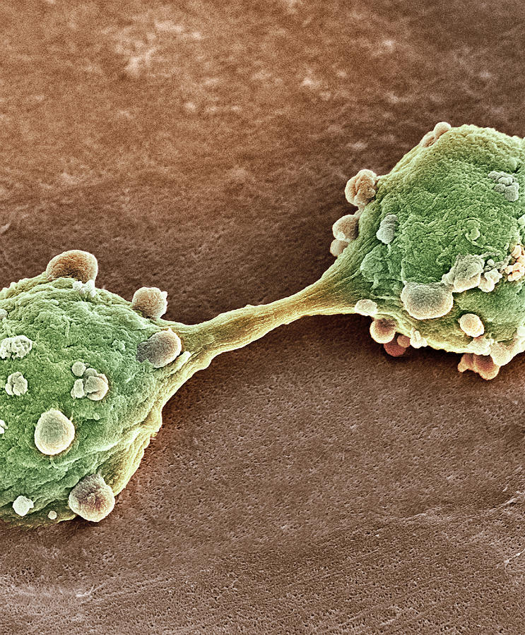 Cancer Photograph - Bladder Cancer Cells Dividing, Sem #1 by Steve Gschmeissner