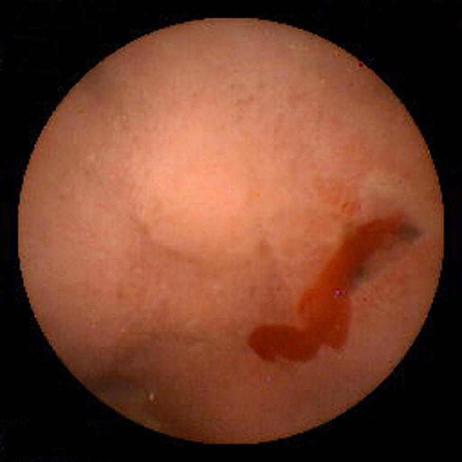 Blood Photograph - Bleeding Duodenal Ulcer, Pill Camera View #1 by David M. Martin, Md