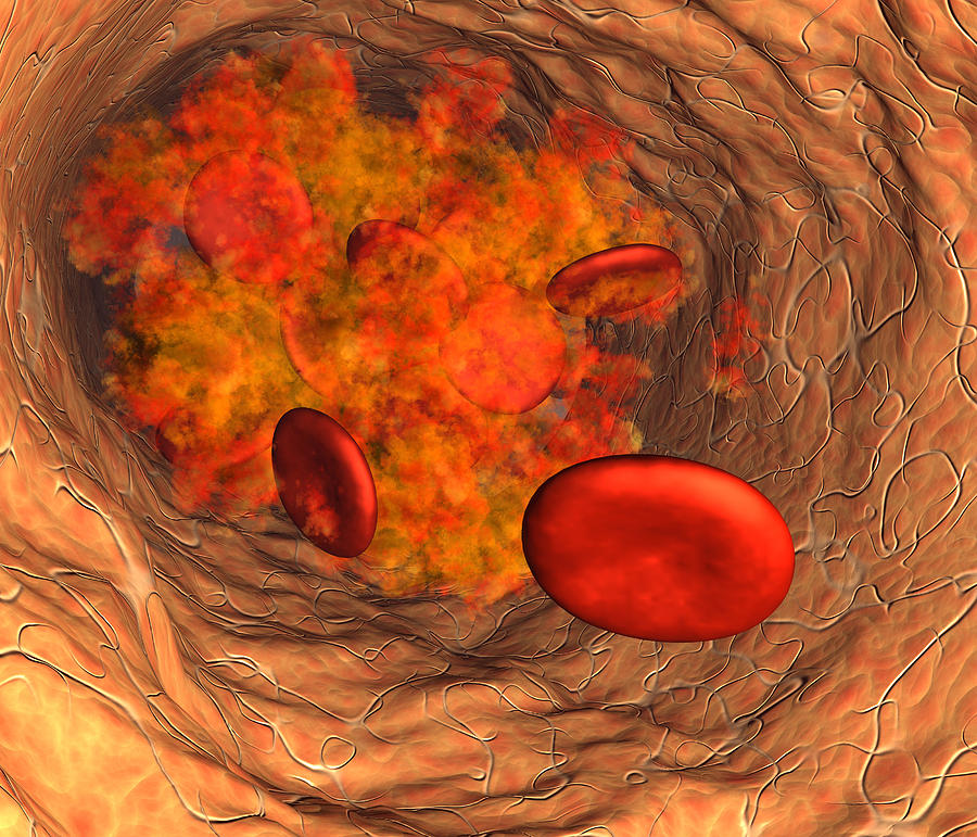 Physiology Photograph - Blood Clot #1 by Roger Harris