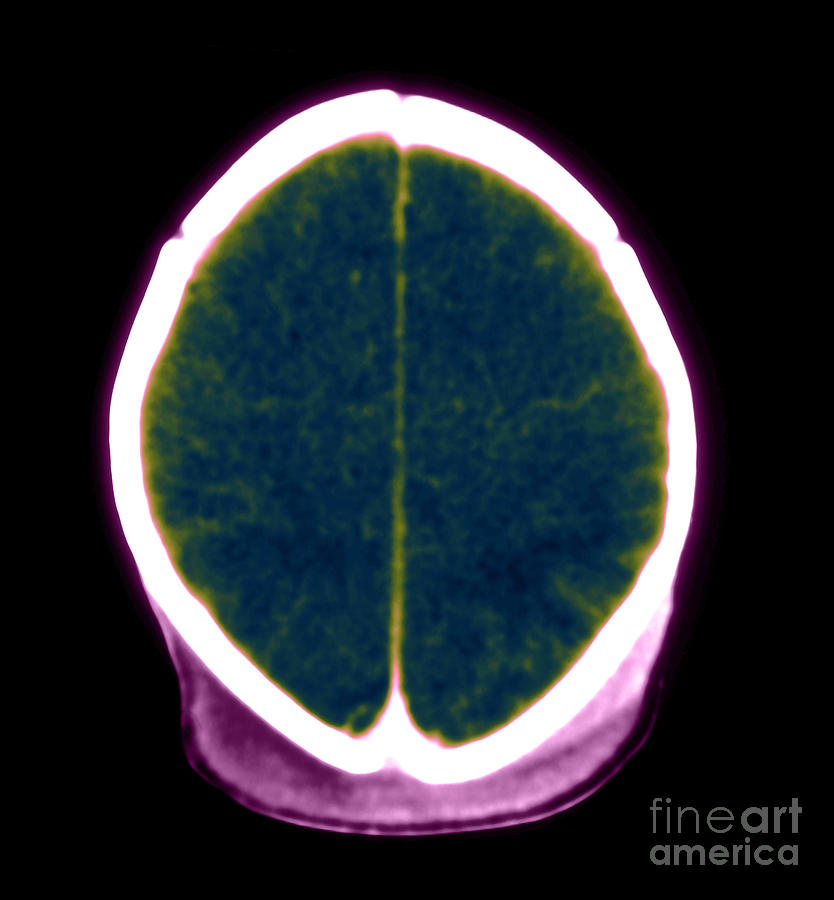Brain Damage From Lack Of Oxygen #1 Photograph by Medical Body Scans