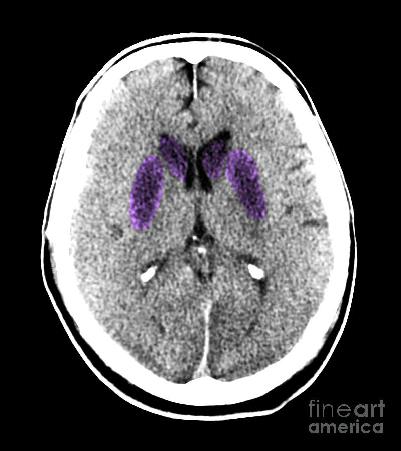 Heart Attack Photograph - Brain Of A Cardiac Arrest Victim by Medical Body Scans Heart Attack Photograph - Brain Of A Cardiac Arrest Victim by Medical Body Scans