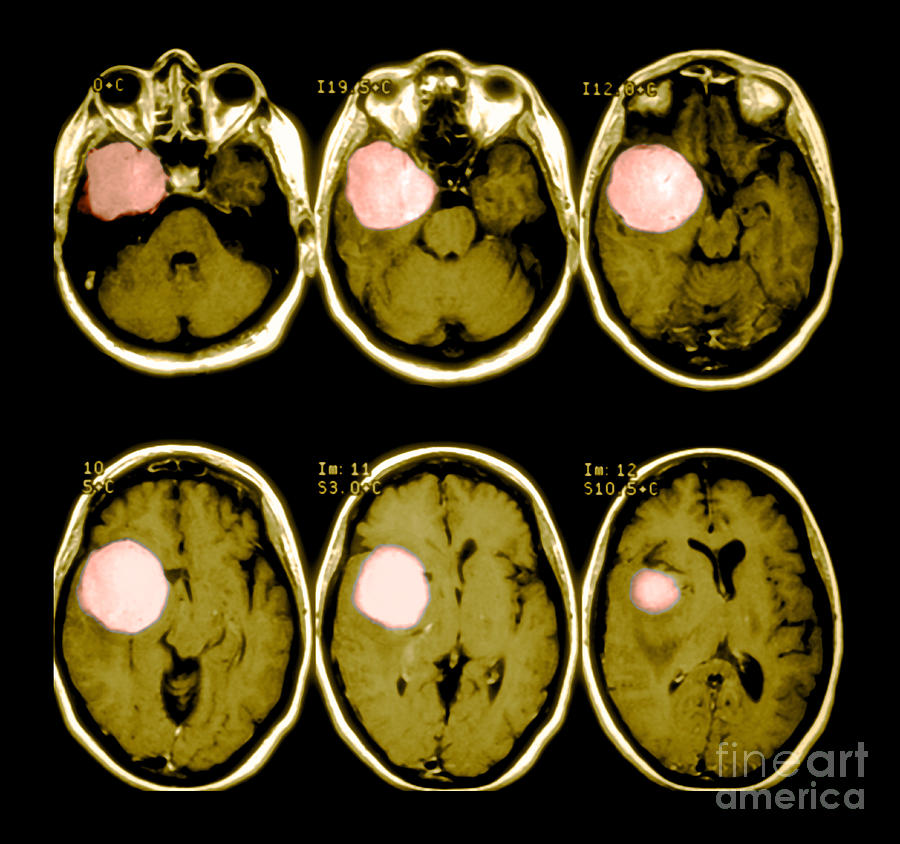 Brain Tumor #1 Photograph by Medical Body Scans
