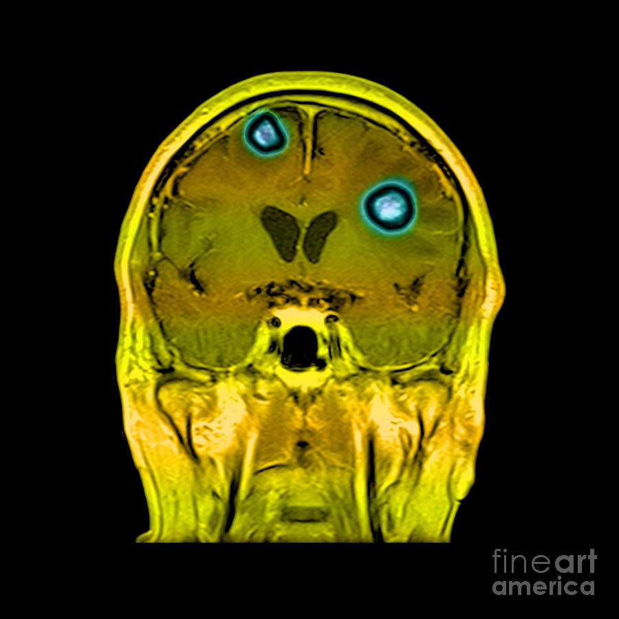 Brain Tumors #1 Photograph by Medical Body Scans