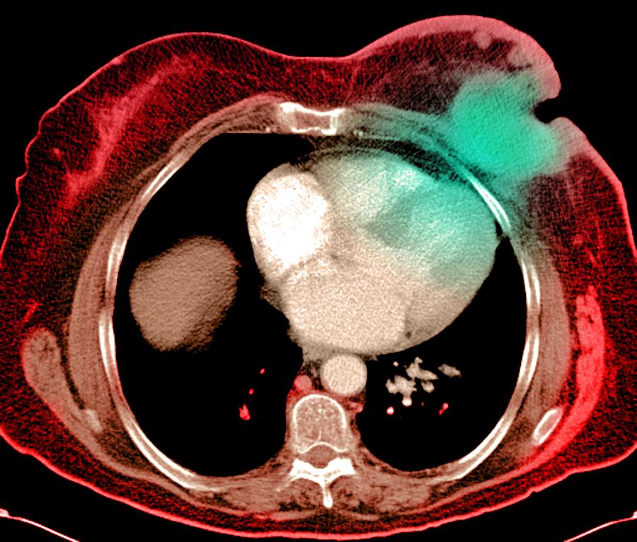 Breast Cancer Ct Scan Photograph By Du Cane Medical Imaging Ltd Fine