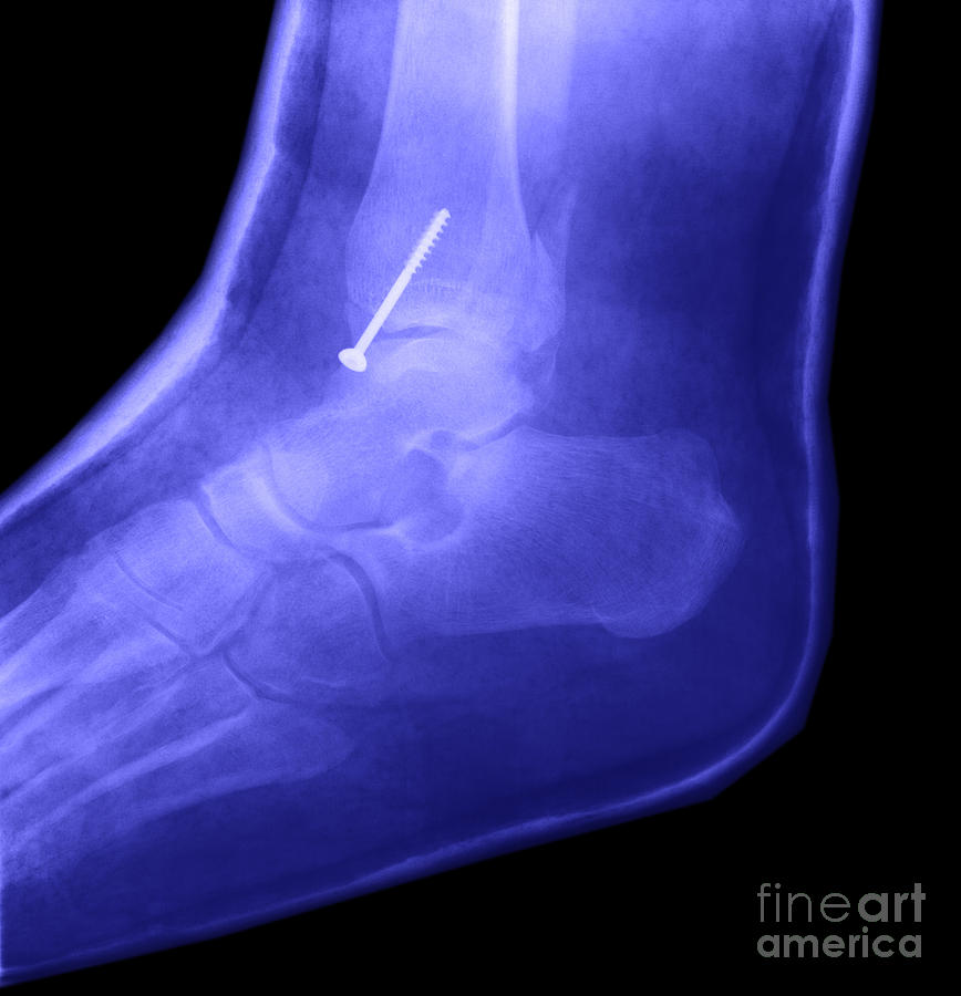 Broken Ankle #1 Photograph by Ted Kinsman
