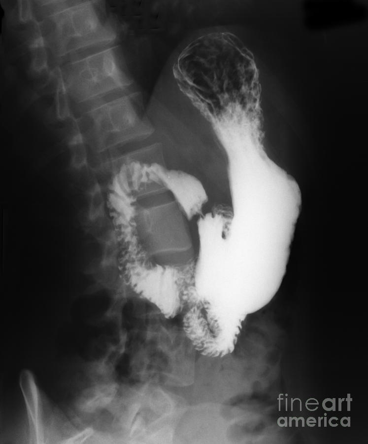 X-ray Photograph - Cancer #1 by Ted Kinsman