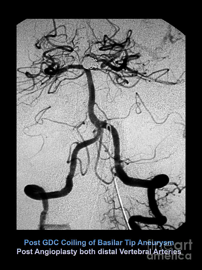 Cerebral Angiogram #1 Photograph by Medical Body Scans