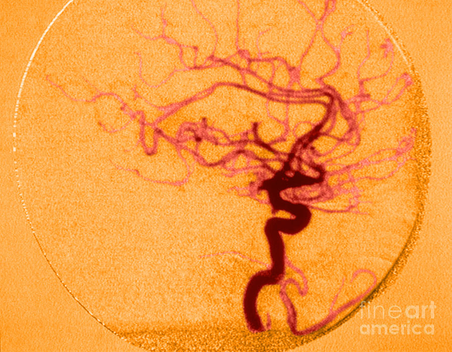Cerebral Angiogram #1 Photograph by Science Source