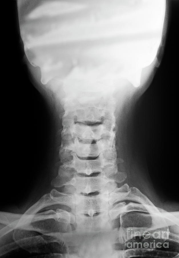 Black And White Photograph - Cervical vertebra and head X-ray #1 by Sami Sarkis