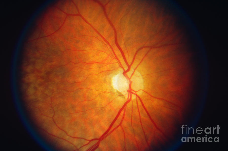 Chiasmal Syndrome Retina #1 Photograph by Science Source