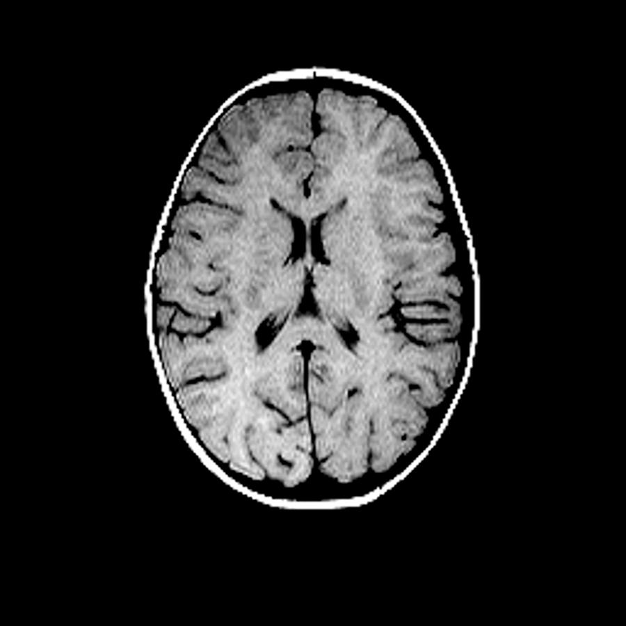 Normal MRI Scan Of Brain