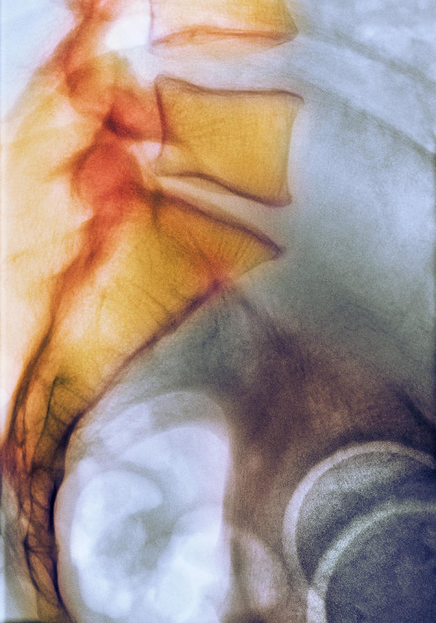 Skeleton Photograph - Coccyx And Lower Back, X-ray #1 by 