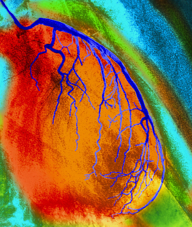 Angiogram Photograph - Coloured Angiogram Of Coronary Artery Of The Heart #1 by 