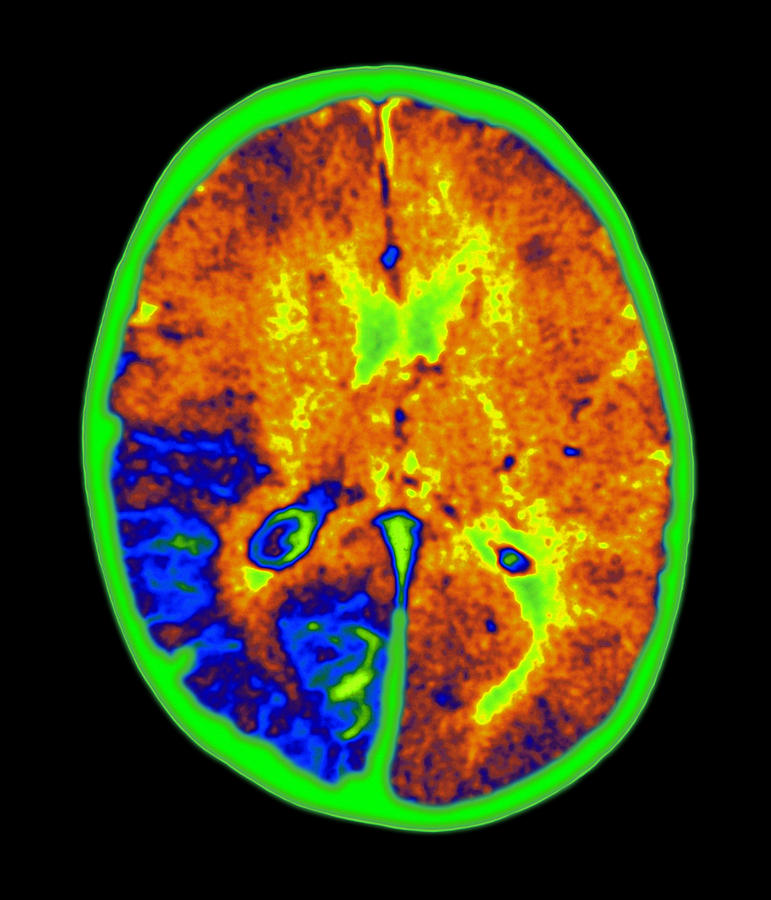 Sturge-weber Syndrome Photograph - Coloured Mri Brain Scan Of Sturge-weber Syndrome #1 by Mehau Kulyk
