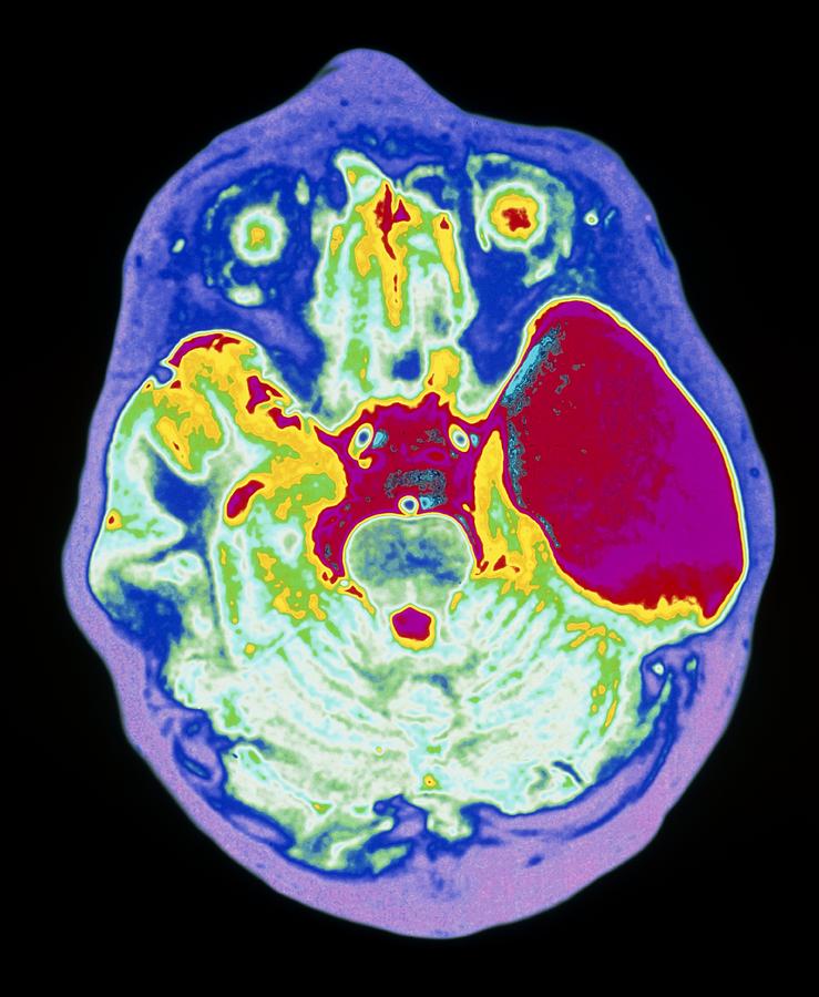 Coloured Mri Brain Scan Showing An Arachnoid Cyst Photograph by Mehau ...