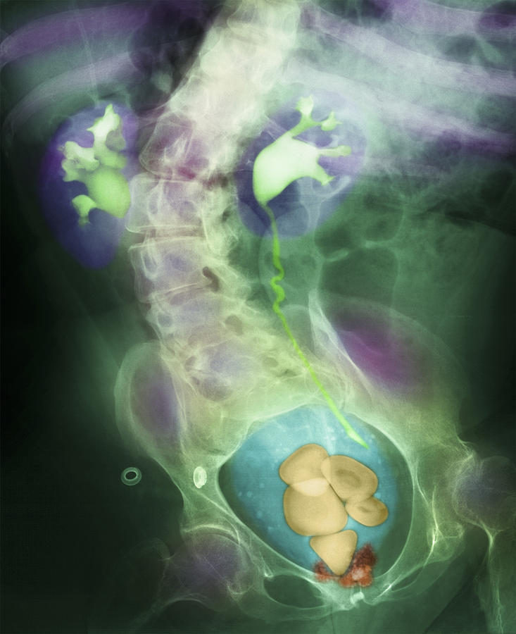 Coloured X-ray Showing Bladder Stones Photograph by - Pixels