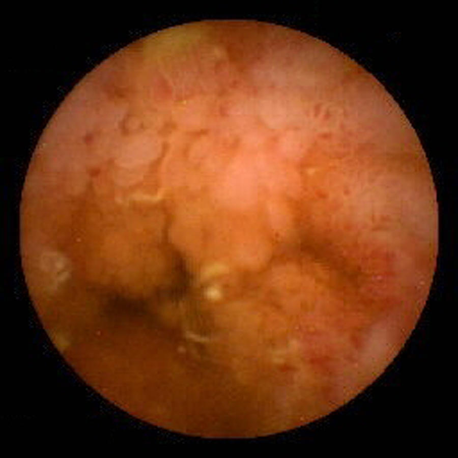Crohn's Disease Photograph - Crohns Disease Inflammation, Pill Camera #1 by David M. Martin, Md