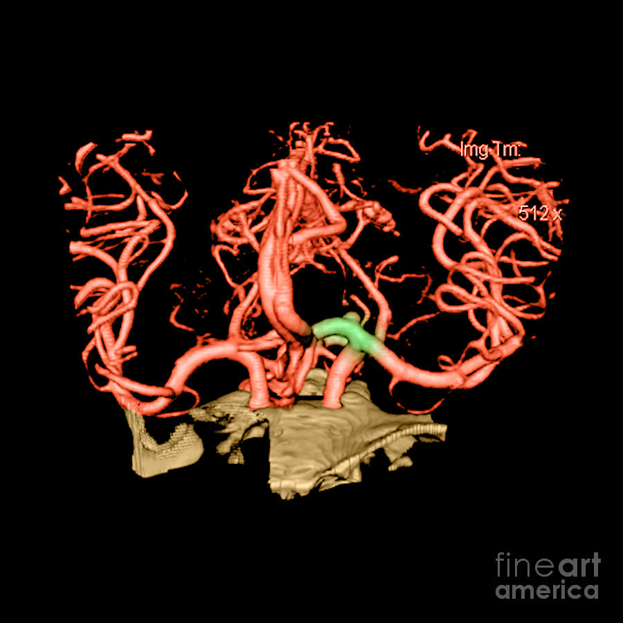 Ct Angiogram Of Aneurysm #1 Photograph by Medical Body Scans