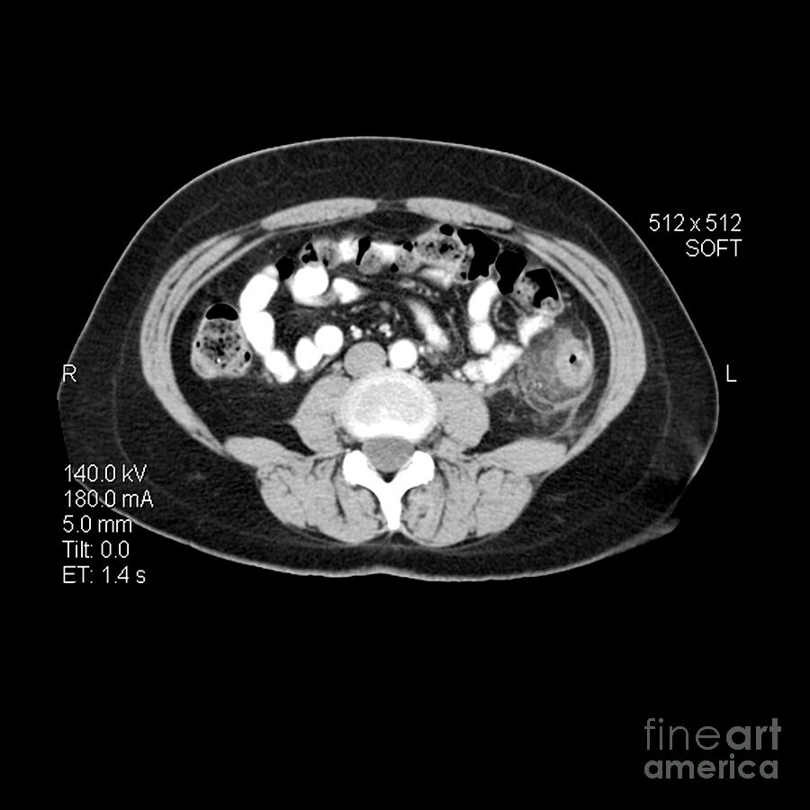 Ct Image Of Diverticulitis #1 Photograph by Medical Body Scans