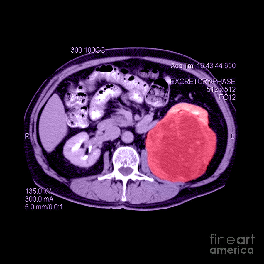 Ct Of Abdomen, Large Renal Carcinoma #1 Photograph by Medical Body Scans