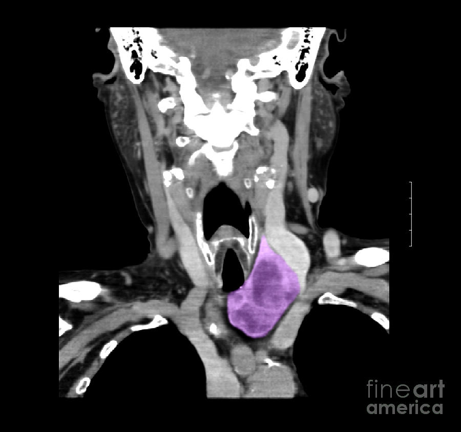 Ct Of Neck Showing Thyroid Goiter #1 Photograph by Medical Body Scans ...