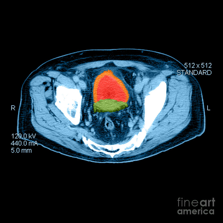 Medical scans for cancer