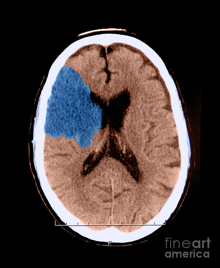 Ct Of Stroke #1 Photograph by Medical Body Scans