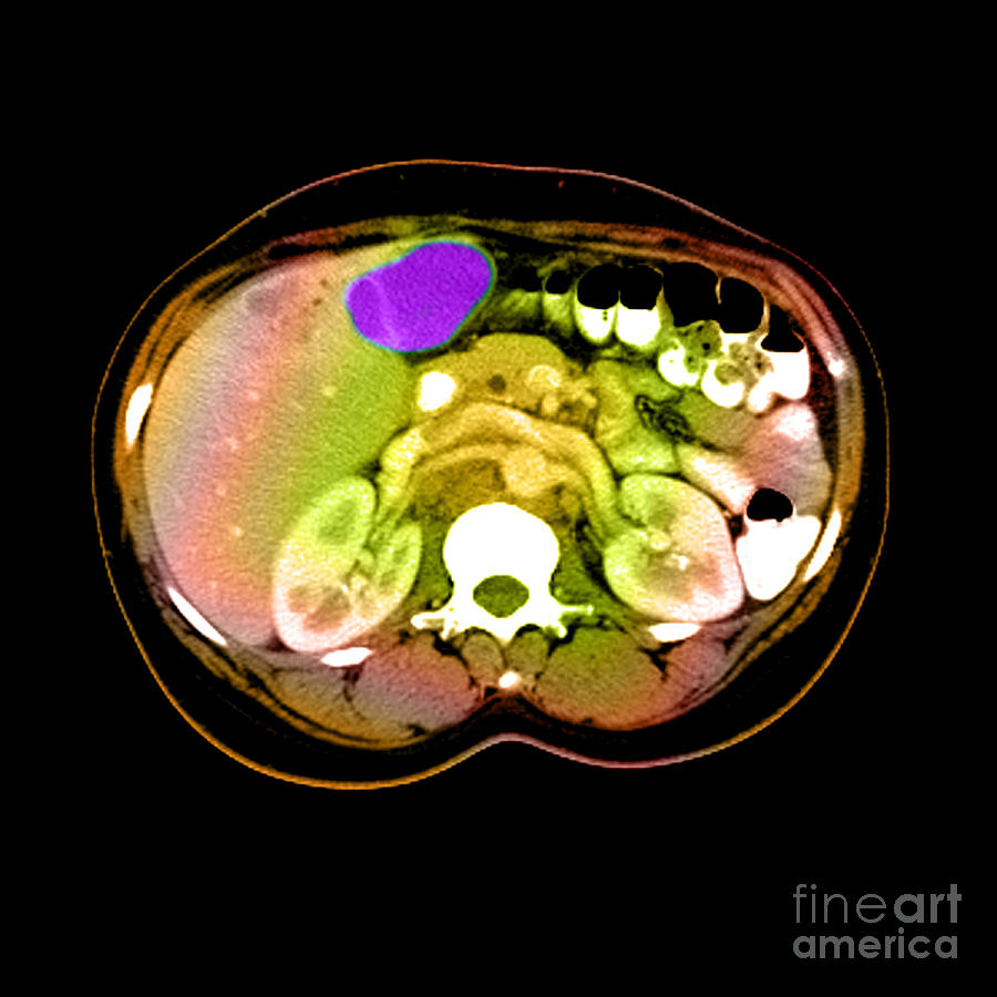 Ct Scan Of A Liver Tumor #1 Photograph by Medical Body Scans