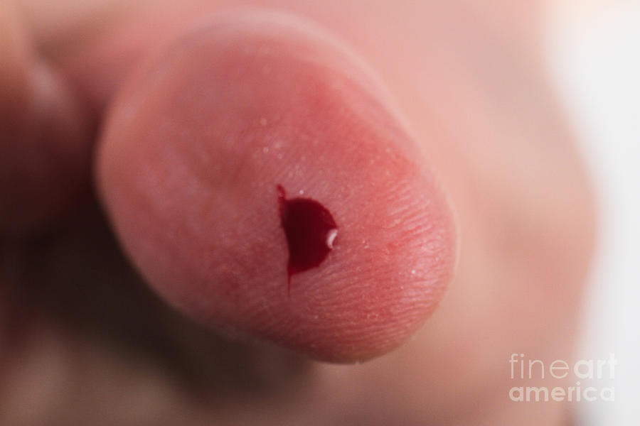 Bleed Photograph - Cut Thumb #1 by Photo Researchers