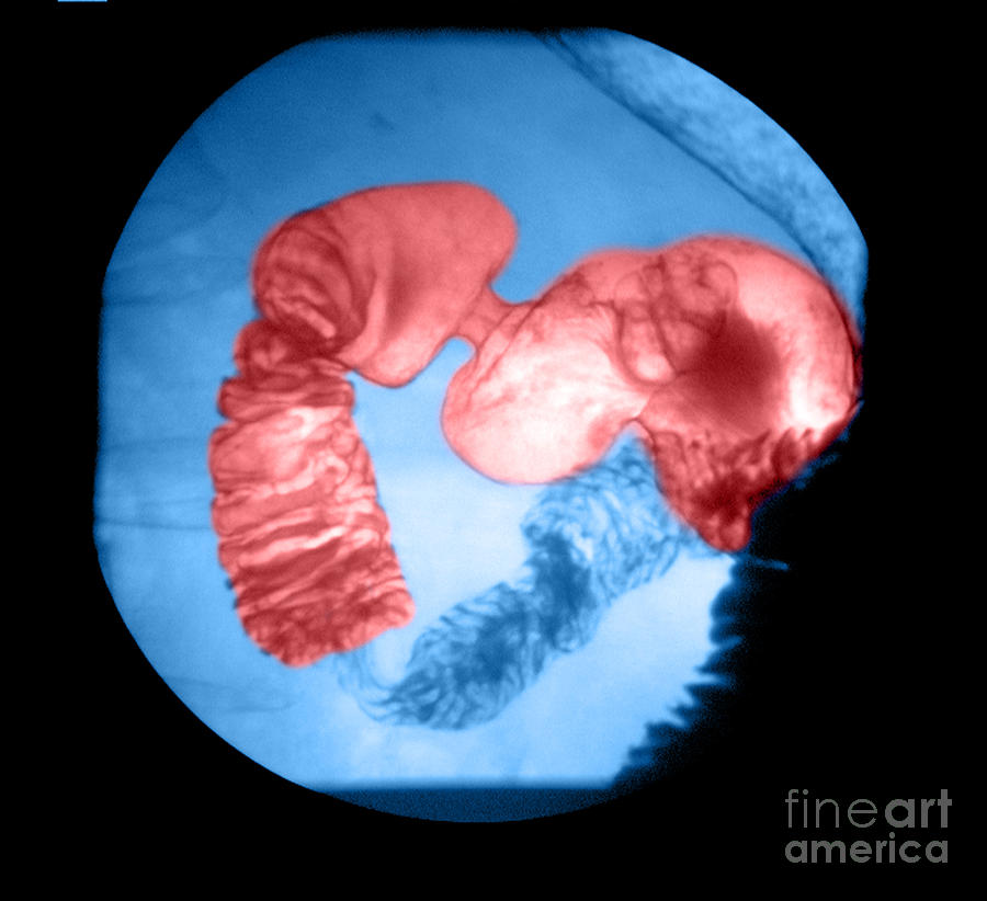 Anatomy Photograph - Distal Stomach And Duodenum #1 by Medical Body Scans