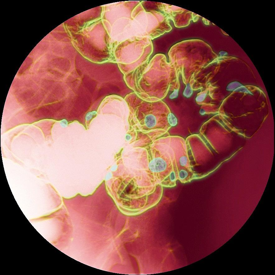 Diverticular Disease X Ray Photograph By Du Cane Medical Imaging Ltd Pixels 9247