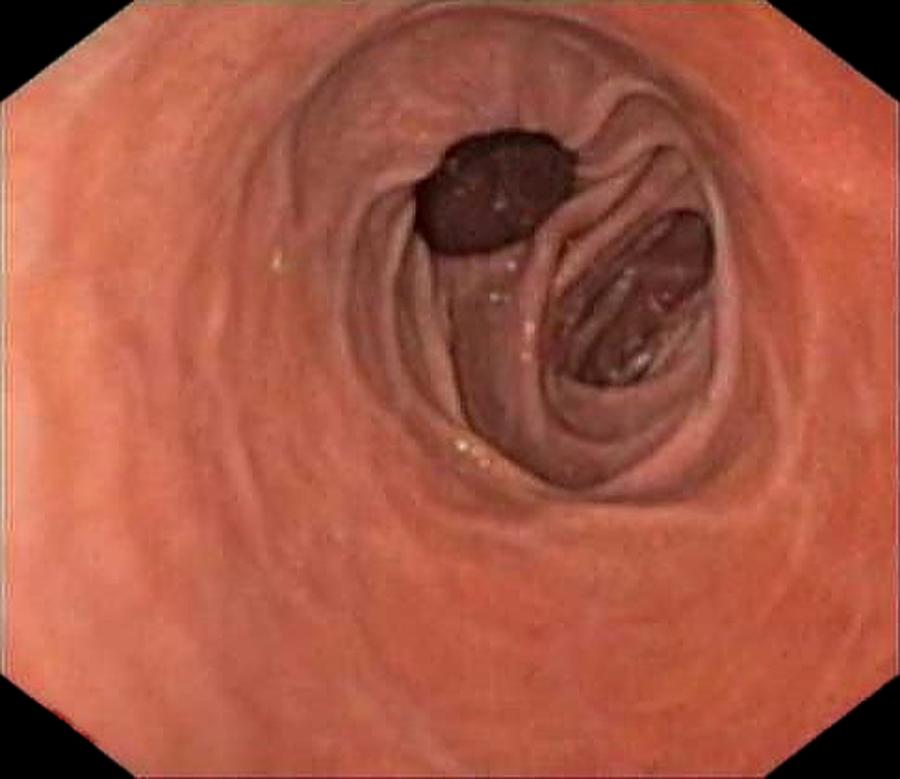Endoscopy Photograph - Diverticulum In The Duodenum #1 by Gastrolab