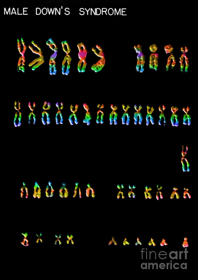 Downs Syndrome Karyotype #1 Photograph by Omikron