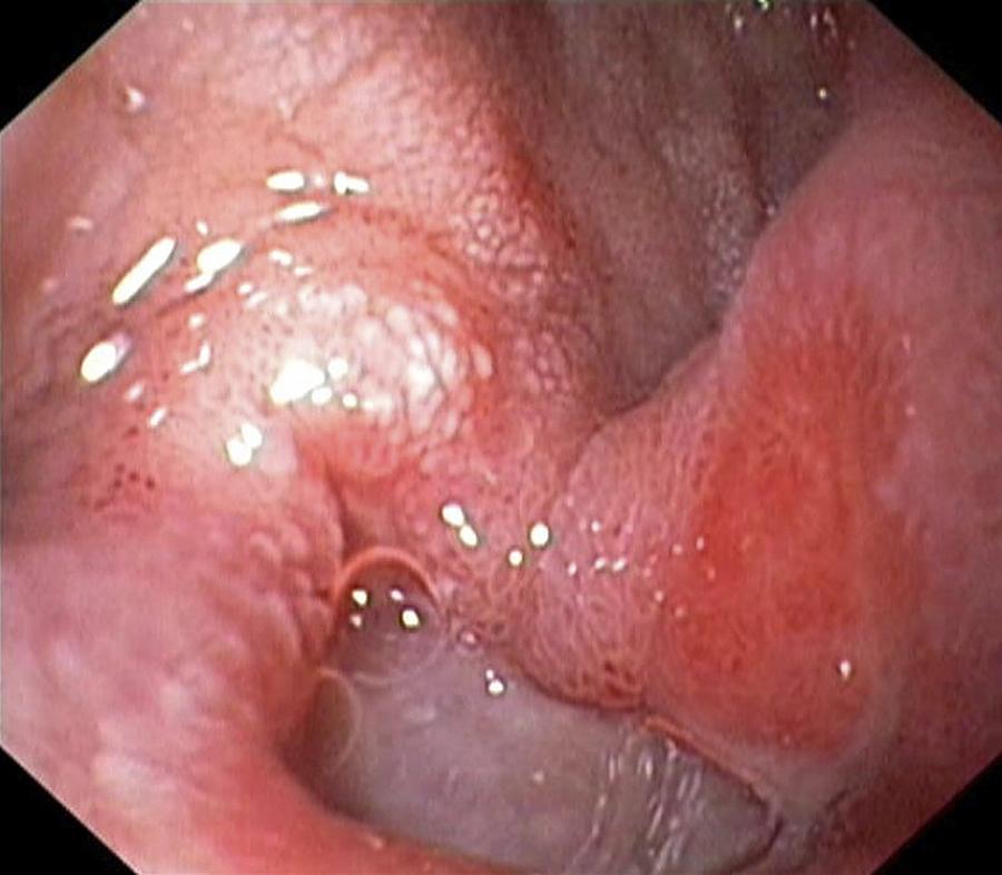 Duodenal Ulcer Photograph - Duodenal Ulcer #1 by Gastrolab