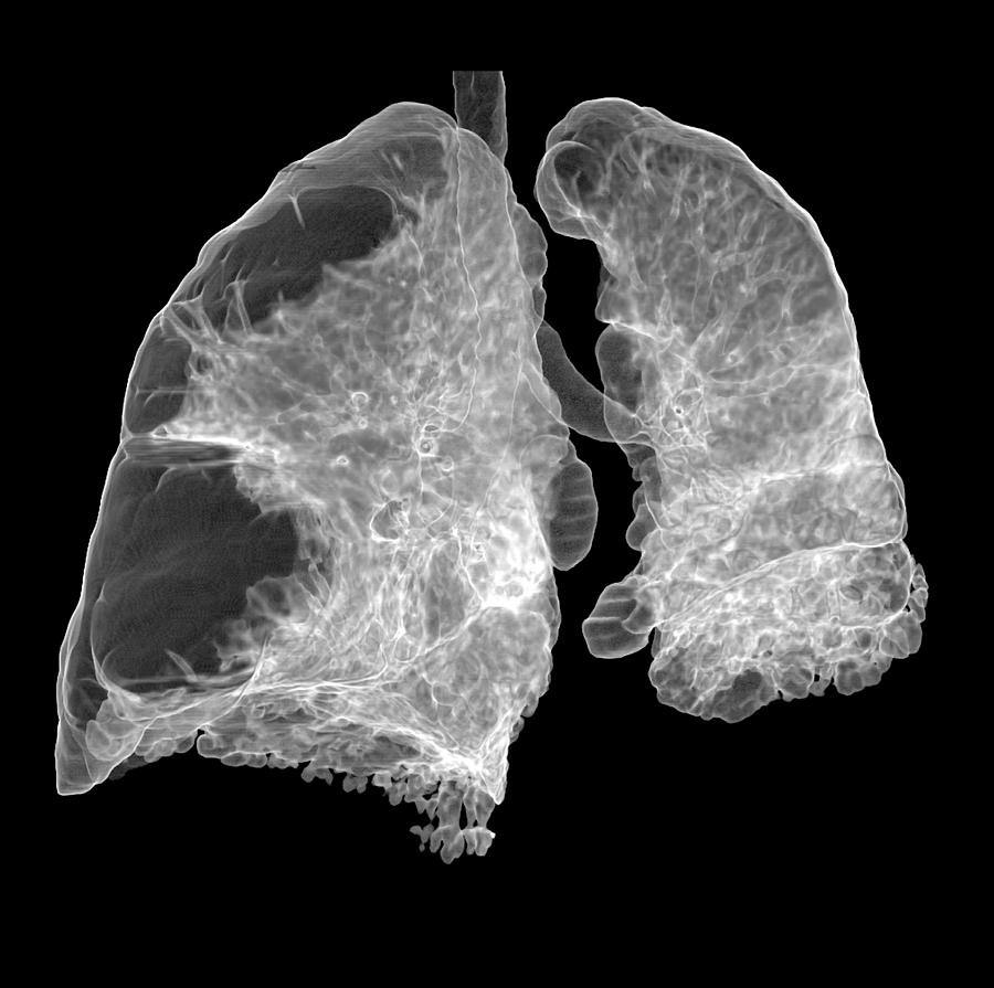 Emphysema Of The Lungs, Ct Scan 1 by Du Cane Medical Imaging Ltd