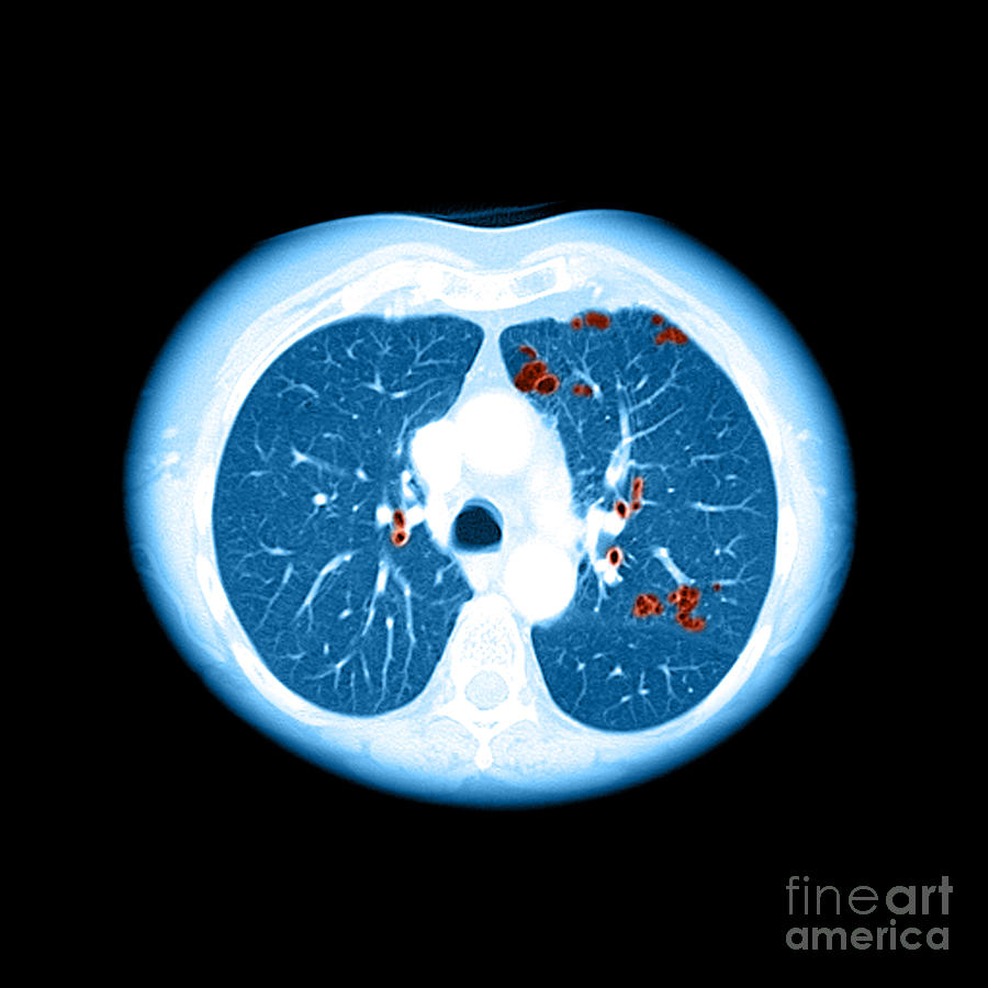 Cigarette Photograph - Emphysema On Ct Chest #1 by Medical Body Scans