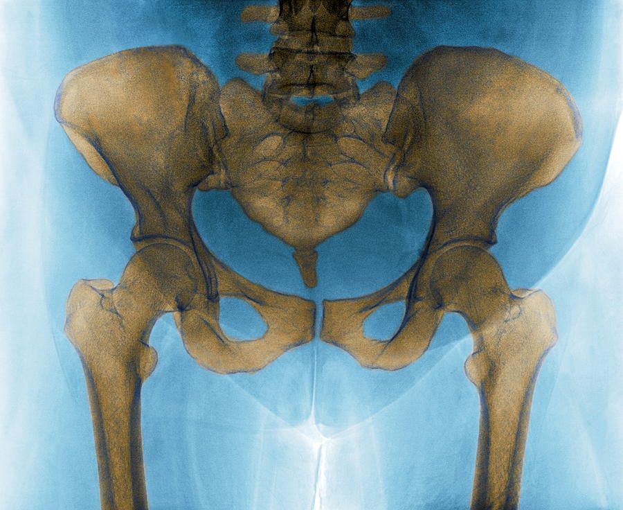 male vs female pelvis x ray