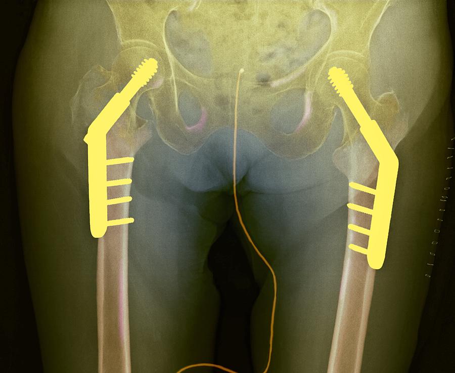 Screw Photograph - Fixed Double Hip Fracture (image 2 Of 2) #1 by Du Cane Medical Imaging Ltd
