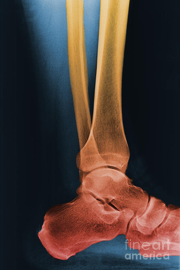 Foot X-ray #1 Photograph by Ted Kinsman