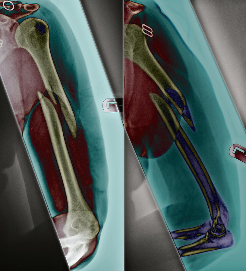 Bone Photograph - Fractured Arm #1 by Du Cane Medical Imaging Ltd