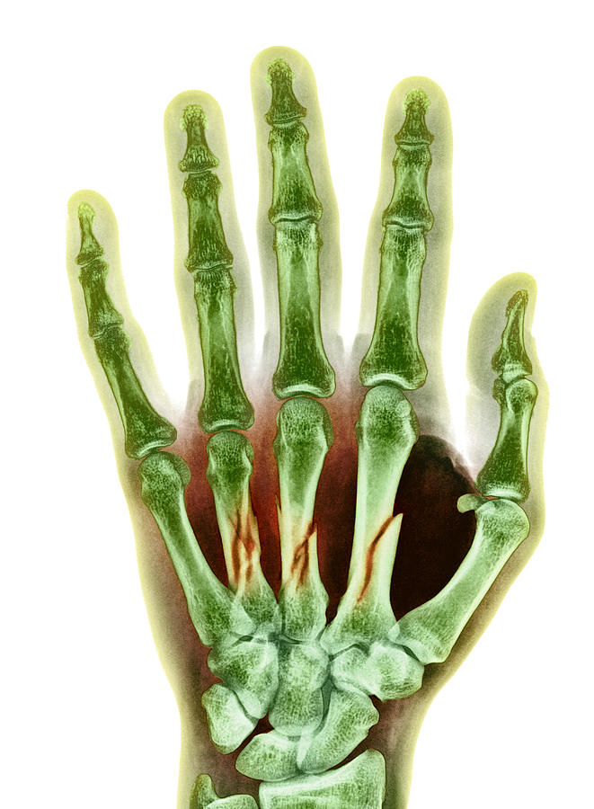 Skeleton Photograph - Fractured Palm Bones Of Hand, X-ray #1 by 