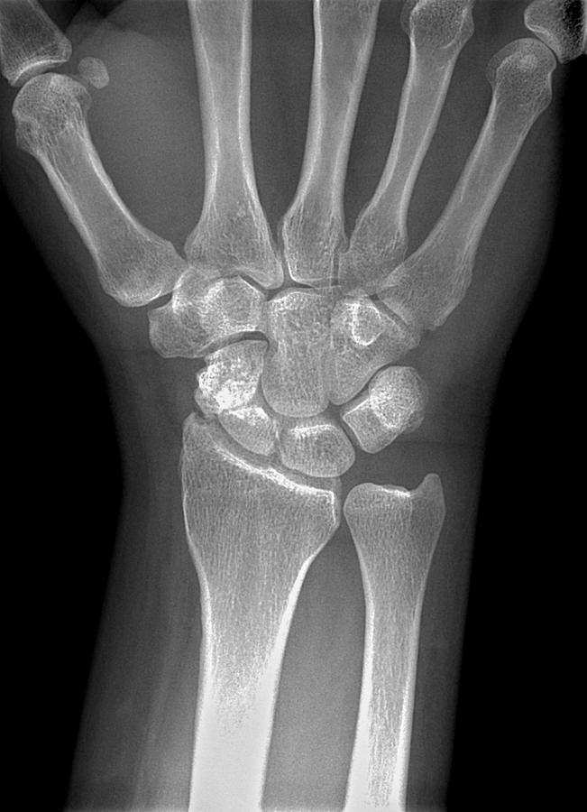 scaphoid fracture x ray
