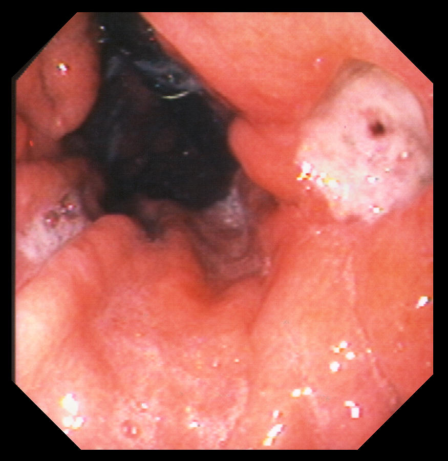 Gastric Ulcer Photograph - Gastric Ulcer #1 by David M. Martin, Md