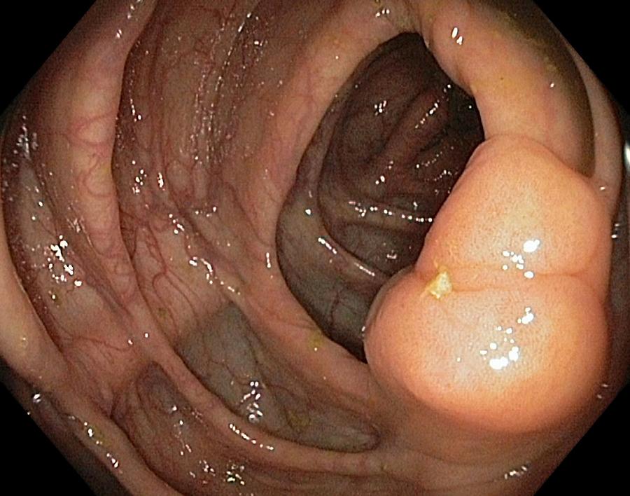 Endoscopy Photograph - Healthy Ileocaecal Valve #1 by Gastrolab